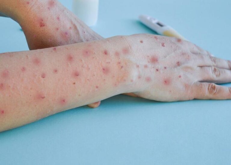 Casos do vírus mpox sobem para 13 em Minas Gerais